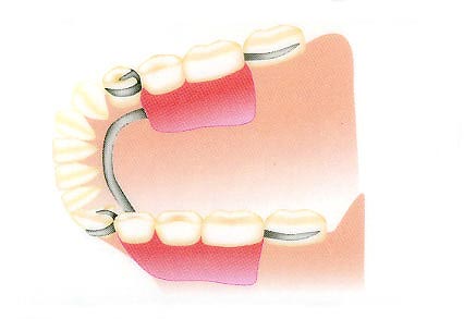奥歯部分入れ歯 従来治療(入れ歯)
